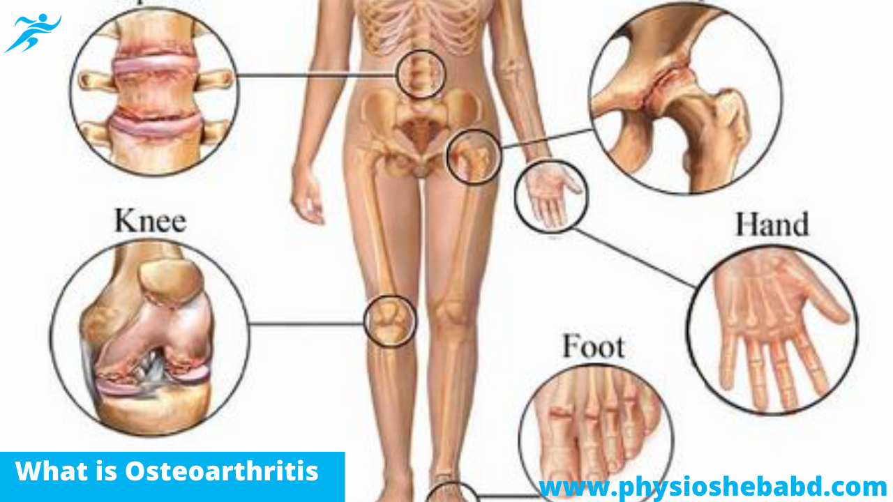 You are currently viewing What is Osteoarthritis-অস্টিওআর্থারাইটিস কি